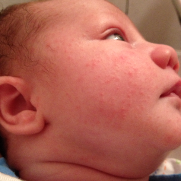 rash-on-infants-face-pictures-photos