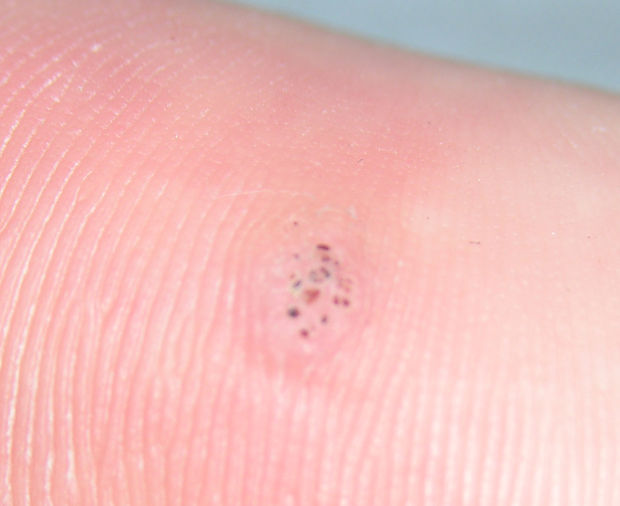 wart on thumb - pictures, photos