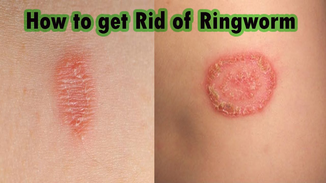 Can Ringworm Spread After Treatment at Margaret Wathen blog