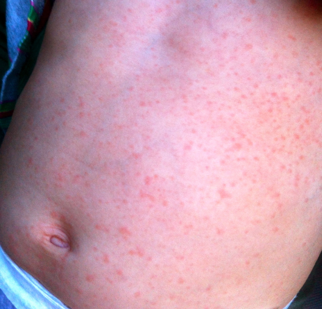 roseola-rash-pictures-in-children-pictures-photos