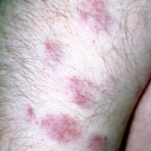 Sarcoidosis Rashes Pictures Photos 6932