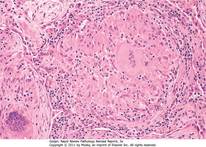 Sarcoid Granuloma - Pictures, Photos