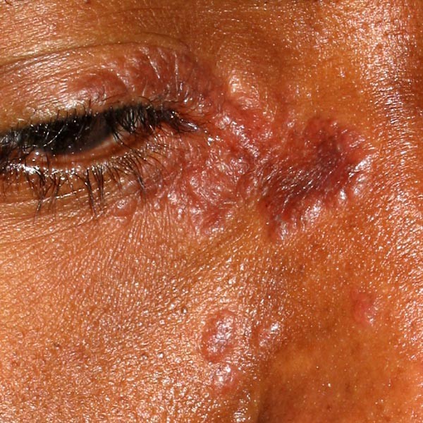 rash on chin pictures, photos