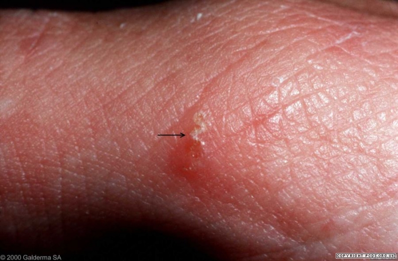 scabie burrows picture pictures, photos