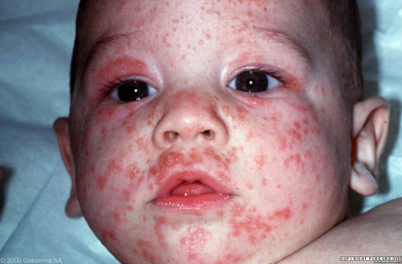 Scabies In Babies Pictures Photos Scabies In Babies Pictures Photos