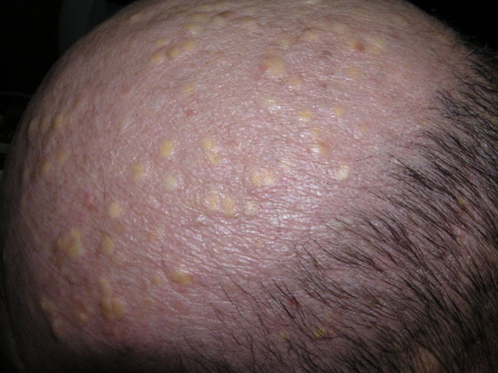 cysts-on-scalp-pictures-photos