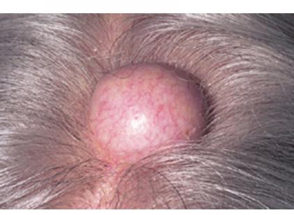 Can You Get Cyst On Your Scalp