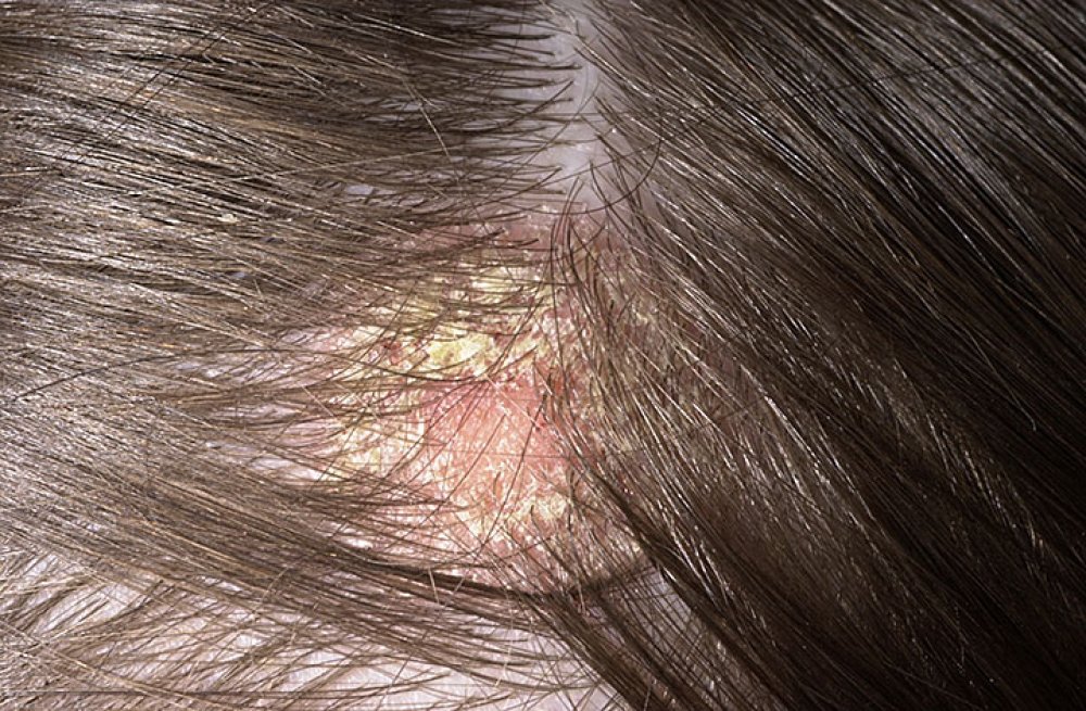 scalp fungal - pictures, photos