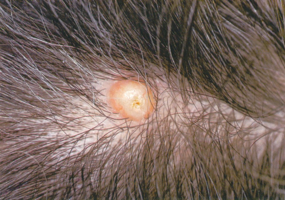 Scalp Infections Pictures Pictures Photos 