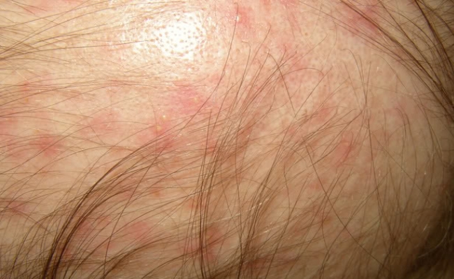 scalp-rashes-treatment-pictures-photos