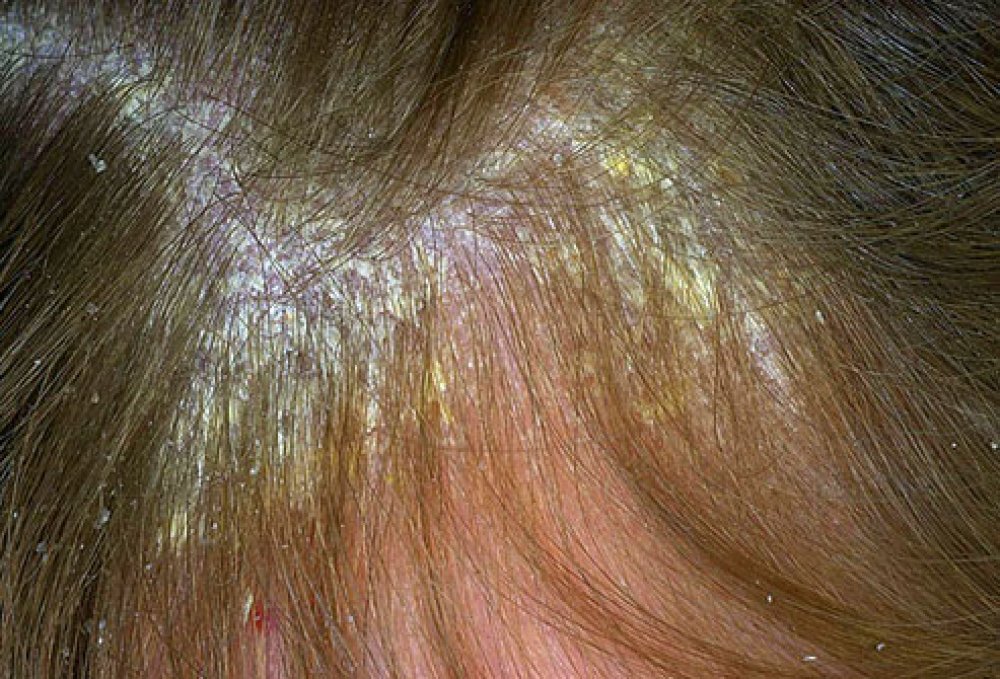 Sores On Scalp Pictures Pictures Photos 