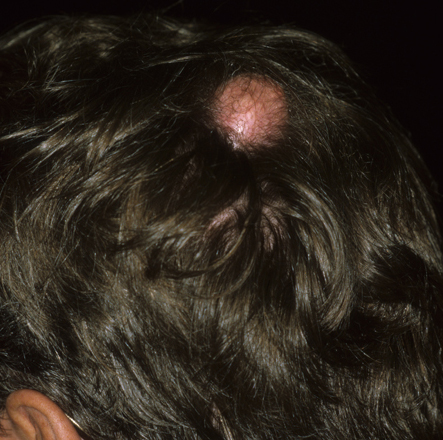 sebaceous cysts on scalp - pictures, photos