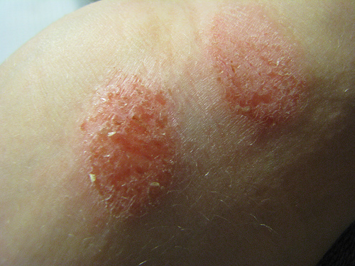 dry-scaly-rash-pictures-photos