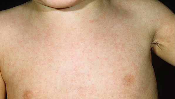 what viruses cause hives in toddlers
