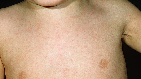 Viral Rashes In Children Causes Symptoms And Prevention