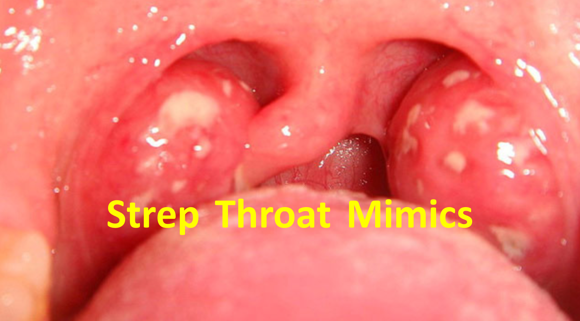 symptoms throat Adult strep