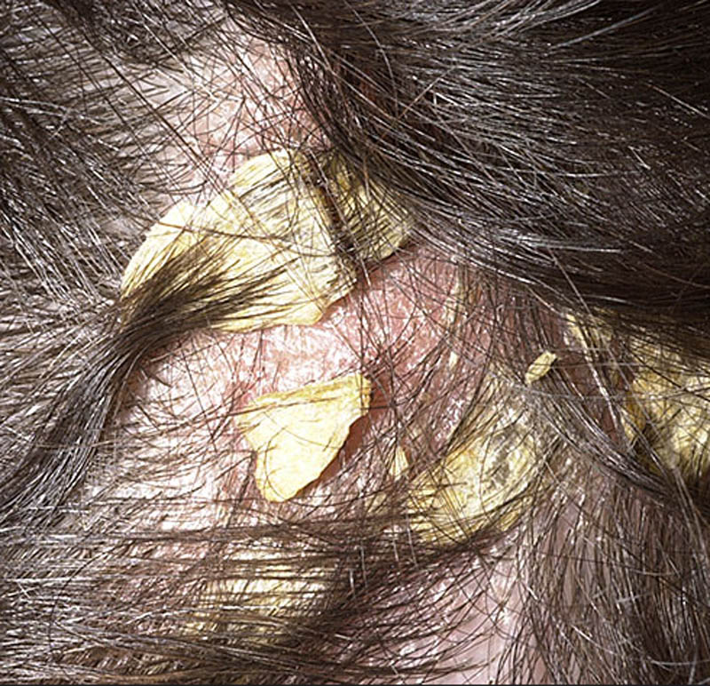 itchy-spot-on-scalp-pictures-photos