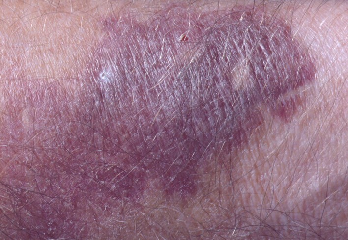 What Causes Large Purple Spots On Your Arms