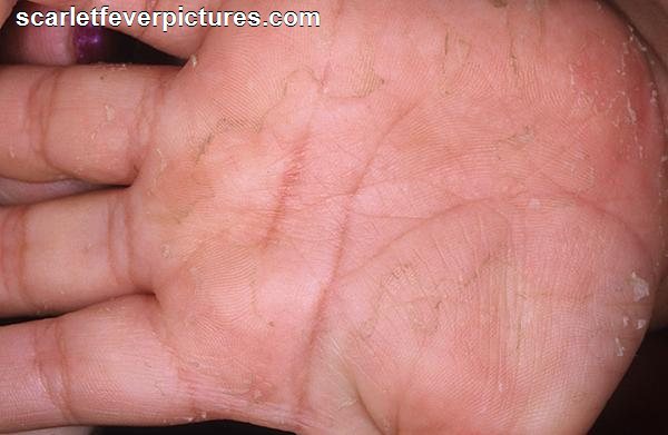 scarlet fever rash itch - pictures, photos