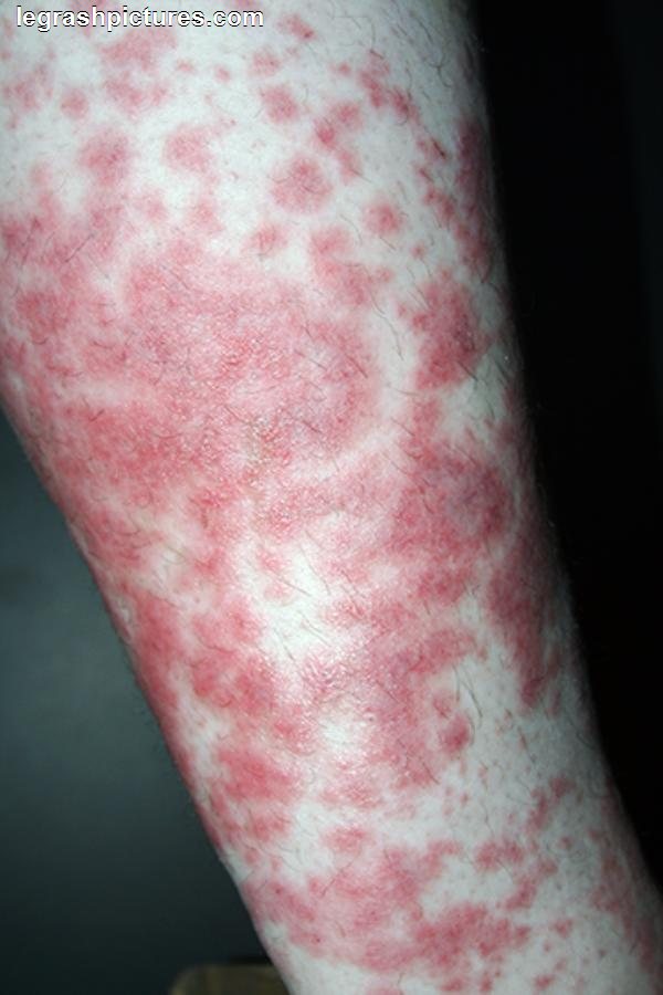 Skin Rash On Legs