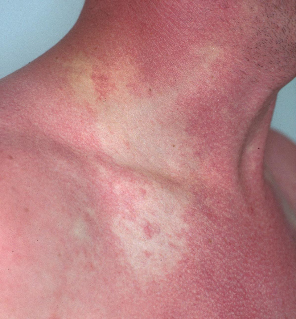 Skin Flushing Pictures Photos