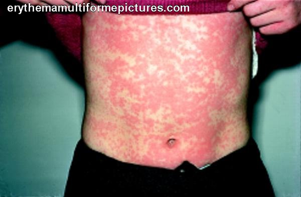 Serum Sickness Treatment - Pictures, Photos