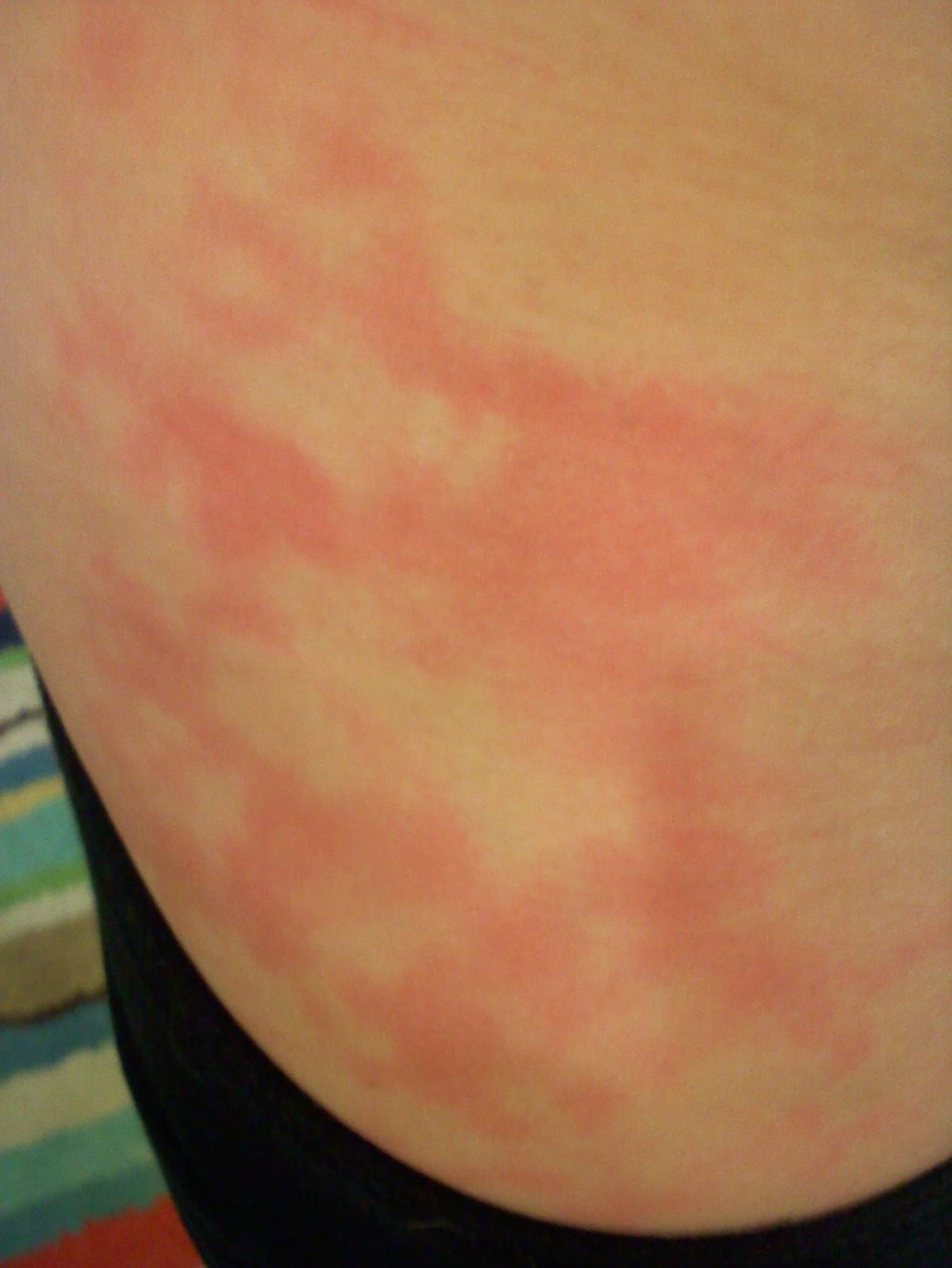 red blotchy rash - pictures, photos