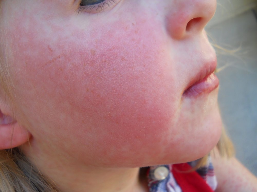 strep-rash-on-face-pictures-photos