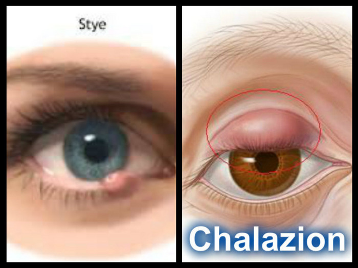 hordeolum vs chalazion - pictures, photos