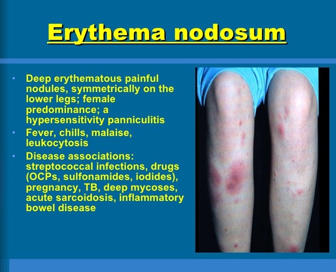 erythema nodosum causes - pictures, photos