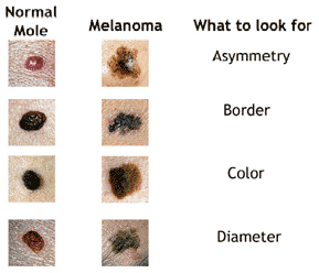 red moles cancerous - pictures, photos