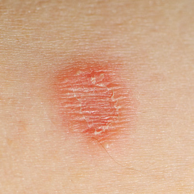 diabetes skin problems - pictures, photos