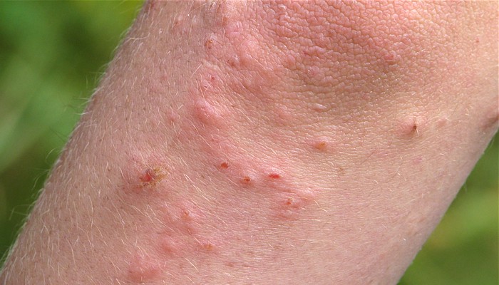 what does poison ivy look like on skin - pictures, photos
