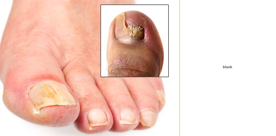 toenail-cracking-vertically-pictures-photos