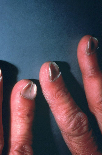 iron-deficiency-nails-pictures-photos