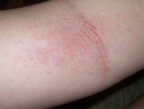 red-splotches-on-arm-pictures-photos