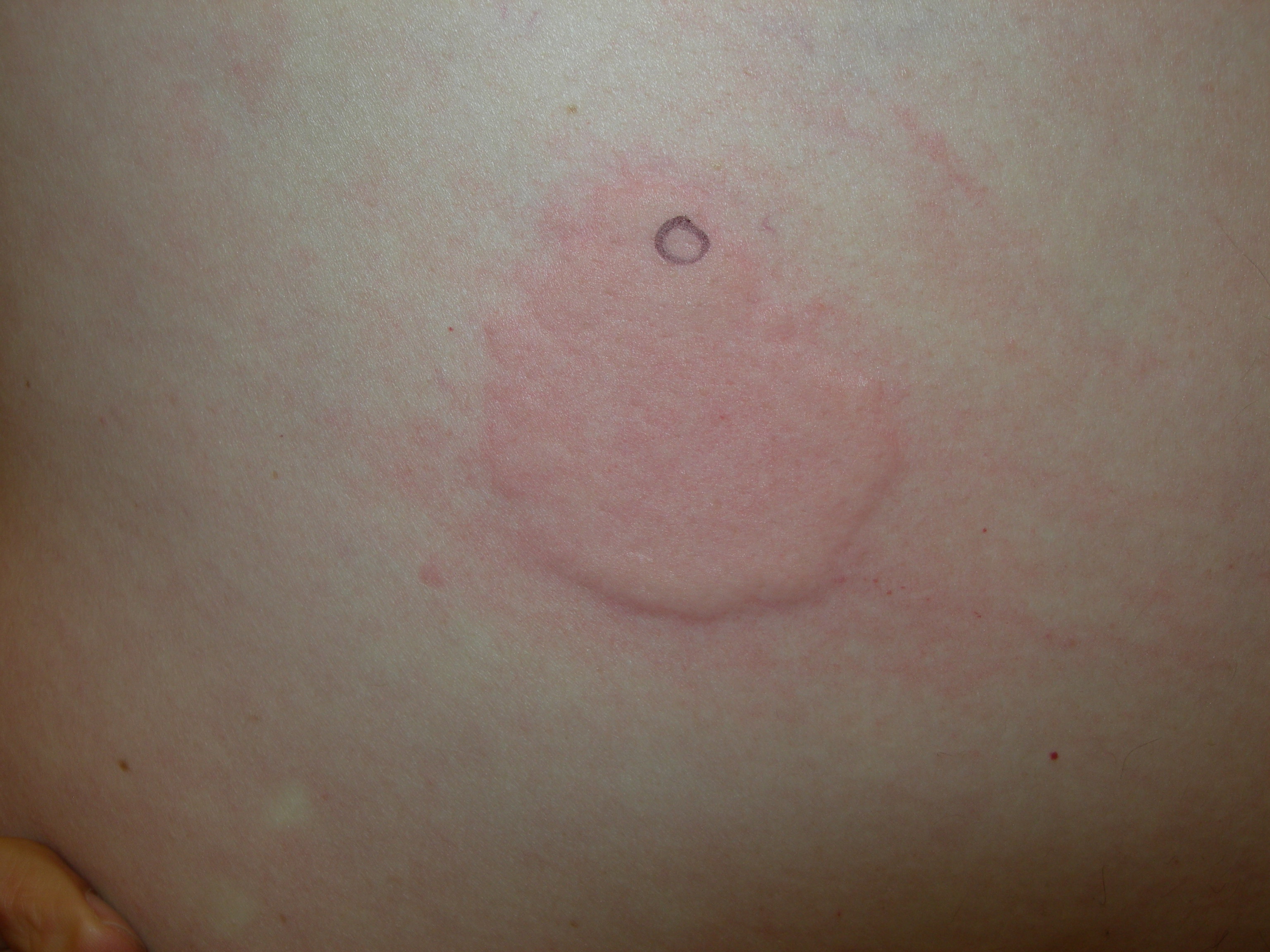 Red Circle On Skin Not Itchy Not Raised