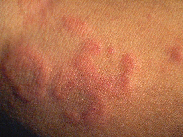 can-alcohol-cause-hives-pictures-photos