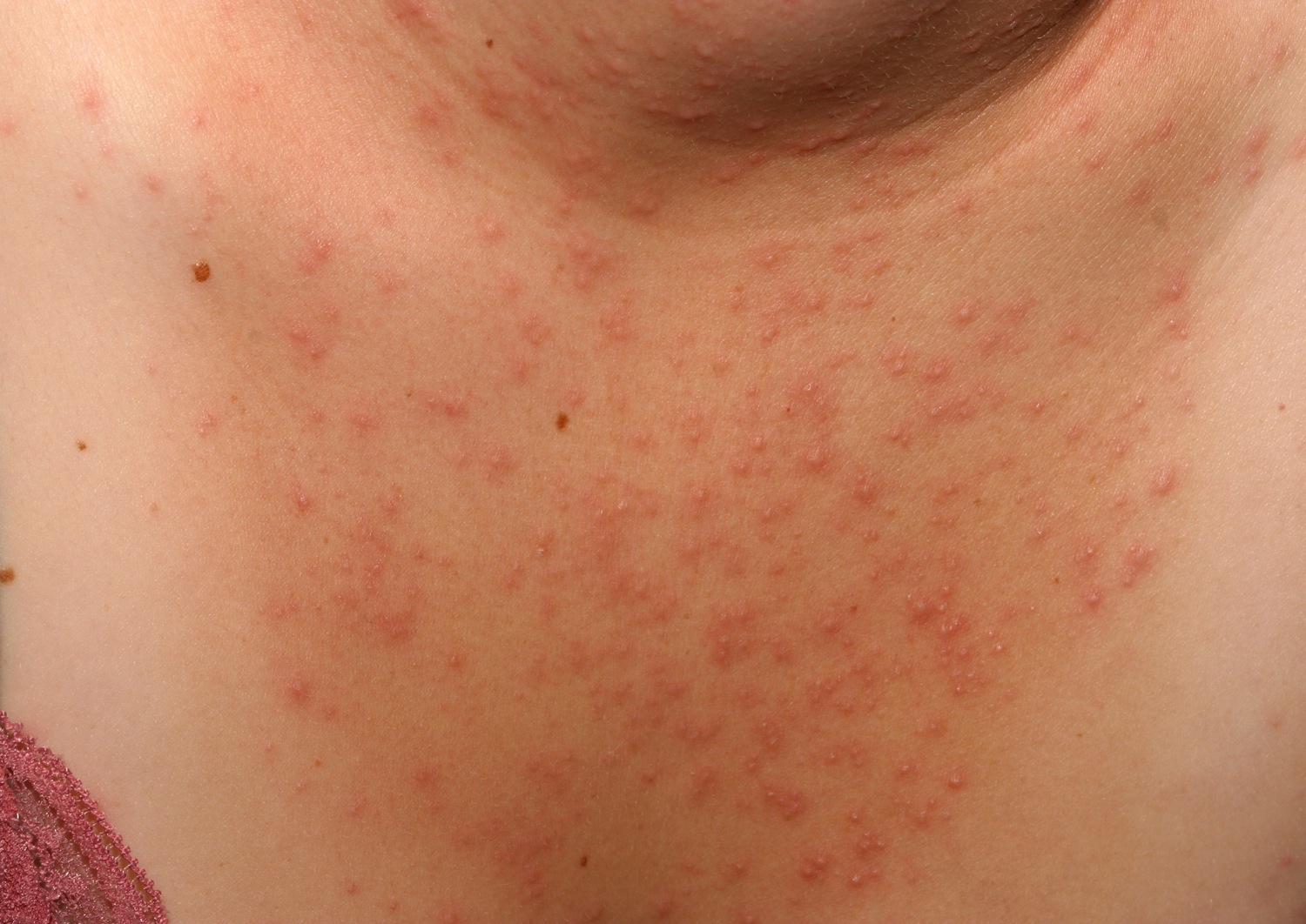 Viral Infection Rash Adults Gue Viral Gambaran