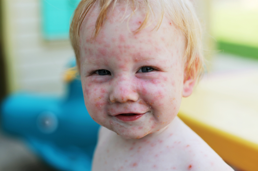 infant chicken pox - pictures, photos