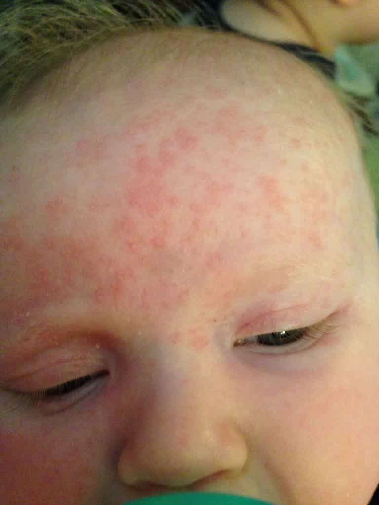 rash on baby forehead pictures, photos