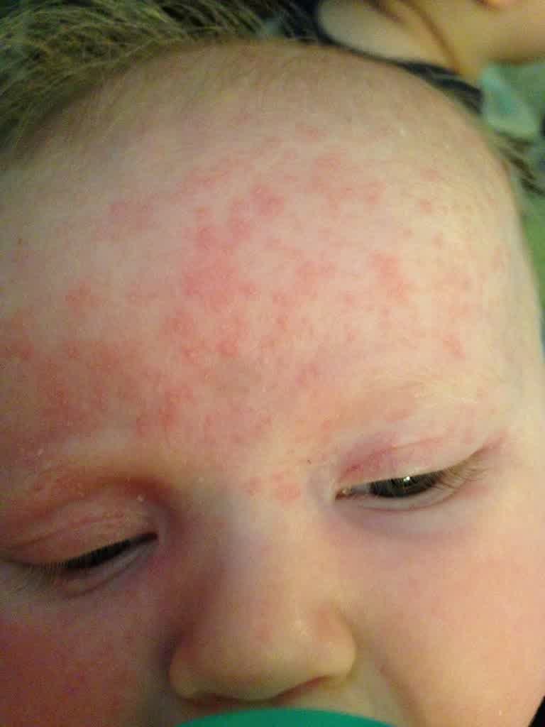 rash on baby forehead - pictures, photos