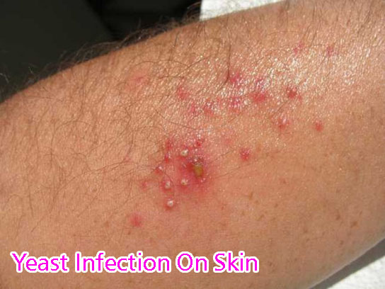 skin-yeast-infection-pictures-photos