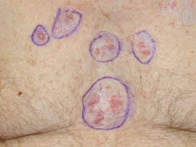 Age Spots Or Skin Cancer 1 