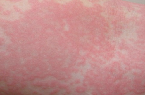 allergic reaction rash pictures - pictures, photos