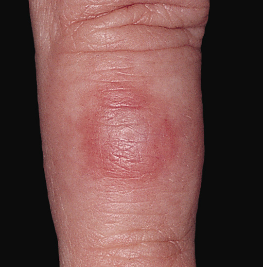 chilblains-treatment-pictures-photos