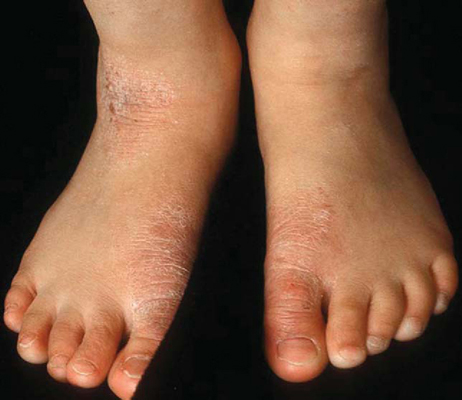 Dermatitis Pictures Feet