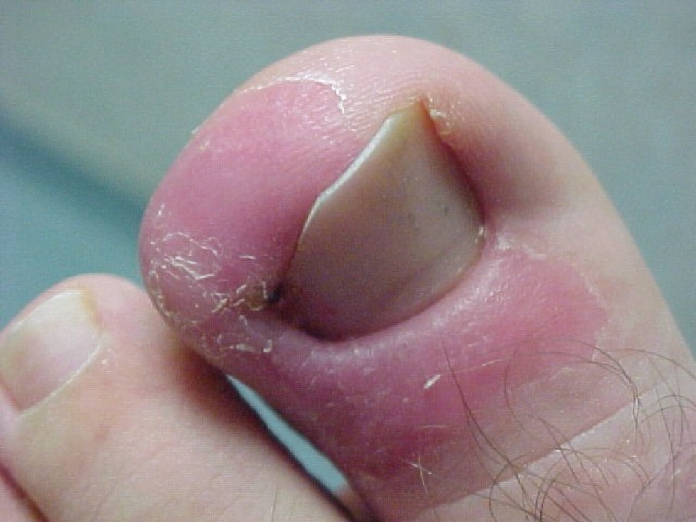 infected-toenail-pictures-photos