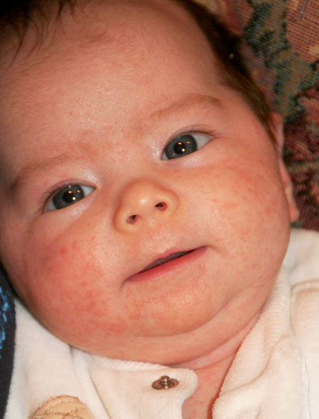 baby acne cause - pictures, photos