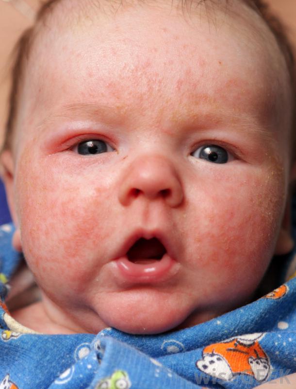 red-bumps-around-baby-eyes-pictures-photos